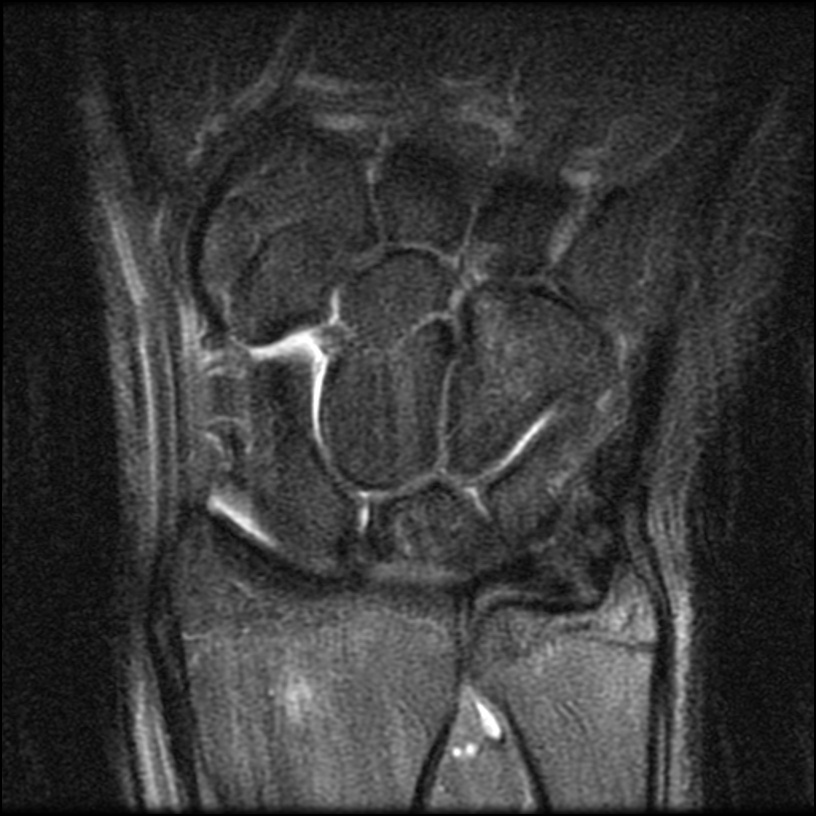 Figure 2 for case ulna stress fracture
